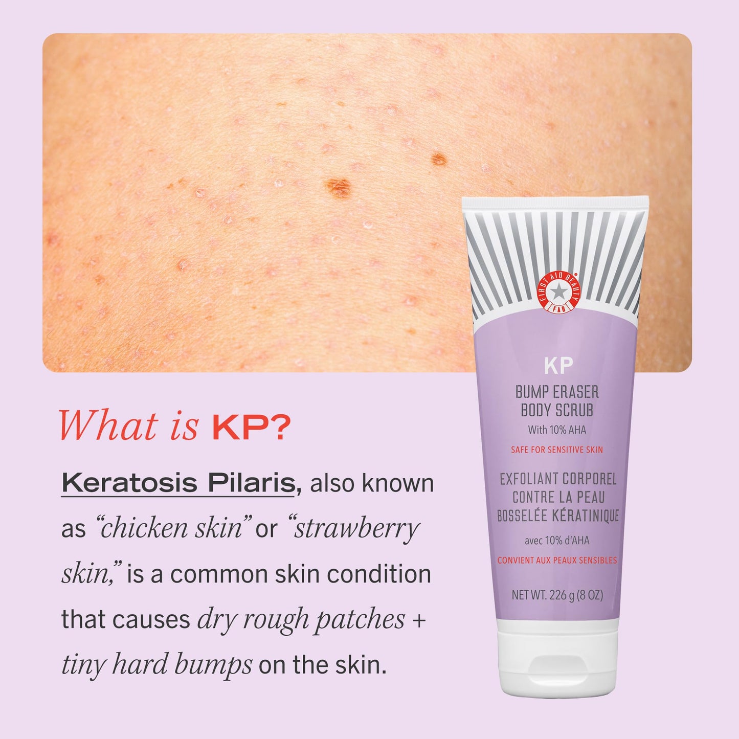 First Aid Beauty KP Bump Eraser Body Scrub Exfoliant for Keratosis Pilaris with 10% AHA